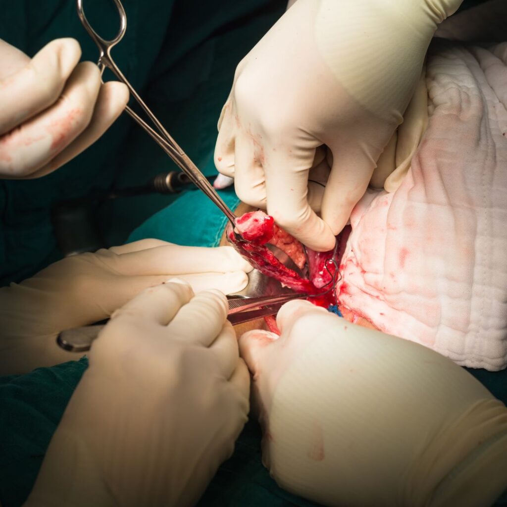 web gala LIGADURA DE ARTERIAS HIPOGÁSTRICAS